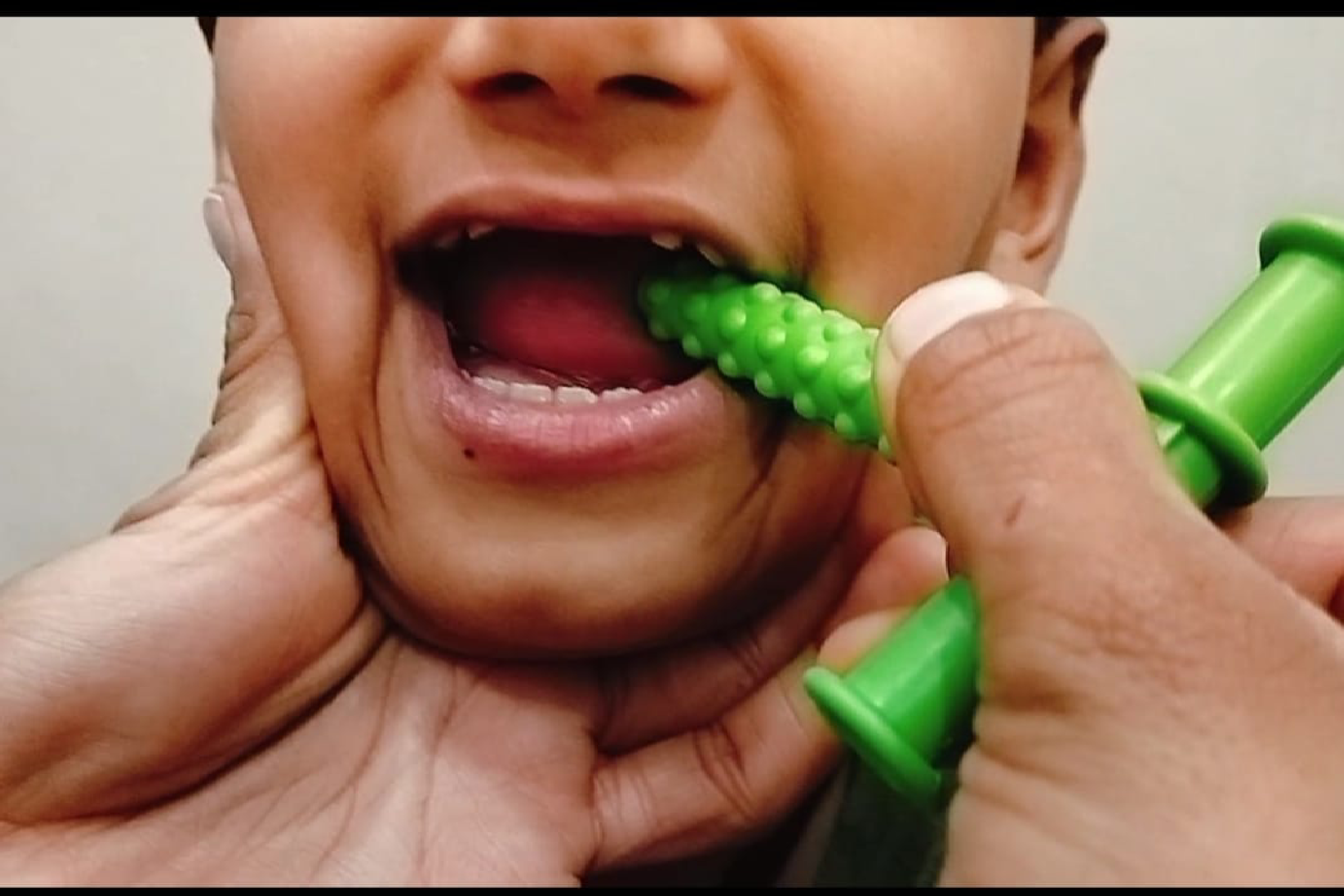 Oral Placement Therapy 1